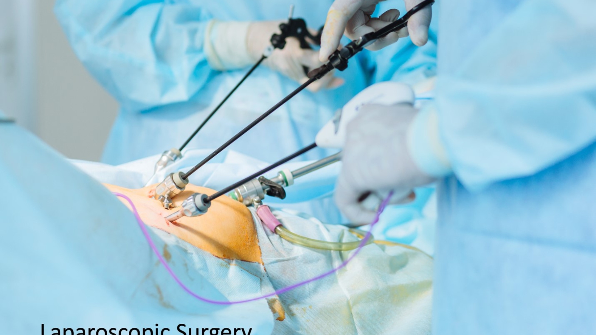 laparoscopic-surgery-1[1]